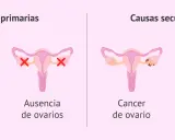 ¿Qué pasa si no te baja la regla en un mes? Causas primarias: retraso pubertad, ausencia ovarios. Causas secundarias: cáncer ovario, menopausia precoz.