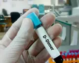 Rękawiczka trzyma probówkę z napisem "D-Dimer". W tle laboratorium, gdzie można dowiedzieć się, d-dimery jak obniżyć.