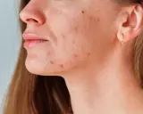 Primer plano de una mujer con granos en el entrecejo y mejillas, mostrando la textura de su piel.