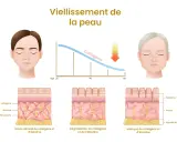 Le vieillissement cutané montre une baisse du collagène, entraînant rides et perte d'élasticité. Quels sont les effets indésirables du collagène ? L'image illustre la dégradation.