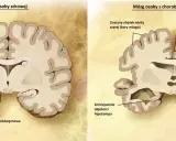 Porównanie mózgu zdrowego i z chorobą Alzheimera: widoczne zmniejszenie hipokampa i kory mózgowej, co jest kluczowe w demencji.