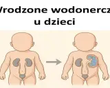 Ilustracja pokazuje rozwój wrodzonego wodonercza u dziecka. Pytanie brzmi: czy wodonercze jest wyleczalne?