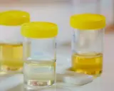 Pojemniki z żółtymi nakrętkami zawierają próbki moczu do analizy. Na stole leży też test diagnostyczny, który może wykryć np. urobilinogen w moczu.