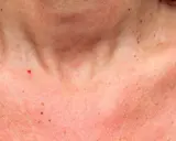 Peau rougie et irritée sur le cou et le décolleté, peut-être une réaction à une allergie au soleil. Combien de temps dure une allergie au soleil ?