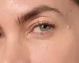 Gros plan sur un œil, montrant une peau claire avec une petite lésion sur la paupière, possiblement un signe de psoriasis paupière.