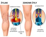 Porównanie żylaków i zdrowych żył. W żylakach zastawka nie działa, powodując zastój krwi. W zdrowych żyłach zastawka zamyka się prawidłowo.