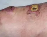 Zmiany skórne, w tym owrzodzenia, mogą być objawem chłoniaka z komórek B. Rokowania zależą od wielu czynników.