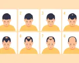 Illustration montrant les 8 stades de la calvitie héréditaire, de la chevelure complète à la calvitie totale.