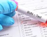 Rękawiczka w niebieskiej rękawiczce trzyma probówkę z napisem "BUN - Test". Zaznaczono pole "BUN", co może wskazywać na badanie w kierunku zatrucia mocznikiem objawy.