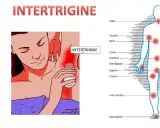 Intertrigine sotto il seno: rimedi della nonna per il rossore. Illustrazione mostra zone colpite da intertrigine.