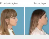 Przed i po zabiegu: poprawa wyglądu twarzy dzięki korekcie wady zgryzu.