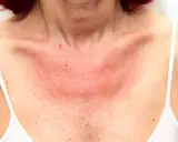 Poitrine rouge et irritée, signe d'une allergie au soleil. Un remède grand-mère pourrait soulager cette peau sensible.