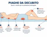 Illustrazione mostra le zone del corpo più a rischio di piaghe da decubito: testa, spalle, gomiti, schiena, glutei, ginocchia e talloni, a causa della pressione prolungata.