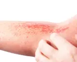 Braccio con eruzione cutanea rossa e pruriginosa, tipica della dermatite atopica. Le dita grattano la pelle irritata.