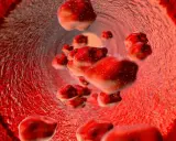 Czerwienica prawdziwa to choroba mieloproliferacyjna, nie nowotwór złośliwy. Widok naczyń krwionośnych z nadmiarem czerwonych krwinek.