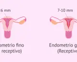 Ilustración comparativa de úteros. Uno muestra un endometrio fino (<6 mm, no receptivo), el otro un endometrio grueso (7-10 mm, receptivo).