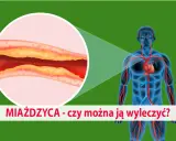 Ilustracja przedstawia ludzkie ciało z widocznym układem krążenia i powiększony przekrój tętnicy z miażdżycą. Jakie badania na miażdżycę są kluczowe?