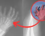 Syndrom obcej ręki: Czy to możliwe, że ręka działa sama? Poznaj prawdę