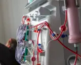 Dializa to często długotrwałe leczenie, ale nie zawsze jest do końca życia. Maszyna do dializy z czerwonymi i przezroczystymi przewodami.