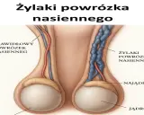 Ilustracja porównuje prawidłowy powrózek nasienny z żylakami powrózka nasiennego. Tak, czy z żylakami powrózka nasiennego można żyć, choć mogą wpływać na płodność.