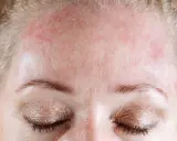 Fronte arrossata e desquamata, un segno di dermatite seborroica. Speriamo in un miracolo dermatite seborroica per ritrovare una pelle sana.