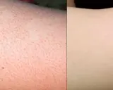 Piel con poros dilatados y vello, aspecto de "strawberry legs", comparada con piel lisa y clara.