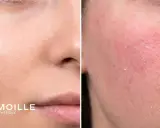 Comparaison de peaux : une saine et une irritée, avec des images microscopiques montrant le microbiome cutané.