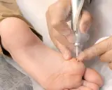 Traitement d'une verrue plantaire au laser par un podologue. Le tarif pour cette intervention est abordable.