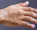 Main d'une personne atteinte de psoriasis, montrant des plaques rouges et squameuses. Une solution à base d'huile essentielle pourrait aider à soulager ces symptômes.