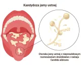 Kandydoza jamy ustnej: białe naloty na języku i podniebieniu, powiększone drożdżaki Candida. Czy kandydoza jest zaraźliwa?