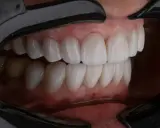 Piękne, zdrowe zęby po leczeniu periodontologicznym. Uśmiech pełen blasku i pewności siebie.
