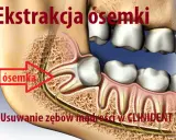 Ósemka na NFZ: Jak usunąć ząb mądrości? Przewodnik krok po kroku