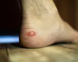 Une phlyctène sur le talon, que faire ? Cette ampoule rouge sur la peau du pied est douloureuse.
