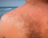 Peau qui pèle après un coup de soleil. La guérison peut prendre plusieurs jours, voire semaines.