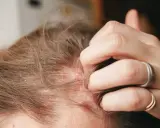 Eine Hand kratzt sich am Kopf, wo rote Stellen und Schuppen auf eine gereizte Kopfhaut hindeuten.