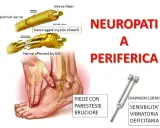 Illustrazione di neuropatia periferica con sintomi come parestesie e bruciore al piede, e diapason per testare la sensibilità vibratoria.