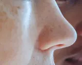 Gros plan sur un nez humain, montrant des pores dilatés et des filaments sébacés. Des taches de rousseur parsèment la peau.