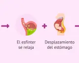 Aumento de progesterona y desplazamiento del estómago en el embarazo causan ardores estomacales.