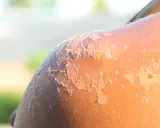Peau qui pèle après un coup de soleil. La guérison peut prendre plusieurs jours, voire une semaine.