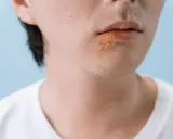Zbliżenie na usta z opryszczką. Szukasz sposobu na opryszczkę w 1 dzień?