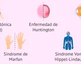 Ilustraciones de distrofia miotónica, Huntington, Marfan, Von Hippel-Lindau y retinosis pigmentaria, ejemplos de herencia autosomica dominante.