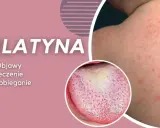 Szkarlatyna: czerwona wysypka na skórze i malinowy język. Objawy, leczenie i zapobieganie. Podobne do rumienia zakaźnego, ale wymaga innej diagnostyki.
