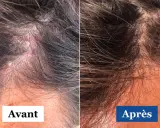 Comparaison avant/après d'un cuir chevelu atteint de psoriasis et dermite séborrhéique. La partie gauche montre des plaques rouges et squameuses, la droite une peau apaisée.