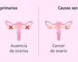Ilustración explica que se puede tener la regla sin sangrar, mostrando causas primarias (retraso pubertad, ausencia ovarios) y secundarias (cáncer ovario, menopausia precoz).