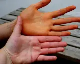 Zwei Hände im Vergleich: Eine ist orange gefärbt, was auf die carotin wirkung hindeutet. Die andere Hand hat eine normale Hautfarbe.