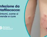 Infezione da stafilococco: cos'è, sintomi, come si prende e cure. Lesioni cutanee infette.