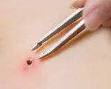 Kawałek kleszcza w skórze? Spokój i instrukcja: weterynarz czy obserwacja?