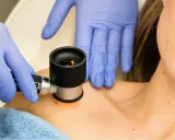 Dermatolog w niebieskich rękawiczkach bada znamię dermatoskopem na skórze pacjentki.