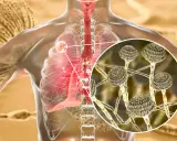 Ingrandimento di Aspergillus fumigatus che infetta i polmoni umani.