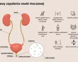 Zaczerwieniona cewka moczowa, objawy zapalenia: ból, pieczenie, częste oddawanie moczu, gorączka, obecność bakterii i białych krwinek.